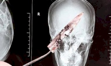 دون أن يدري.. تنزاني يعيش 8 سنوات وشفرة سكين مغروسة في صدره