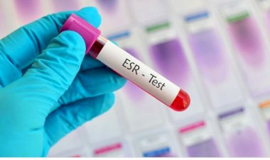 سرعة الترسيب.. متى تتحول من مؤشر عابر إلى ناقوس خطر؟