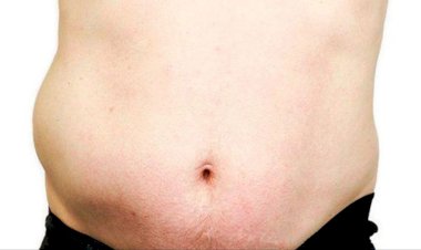 نصائح بعد عملية الفتق الإربي للرجال