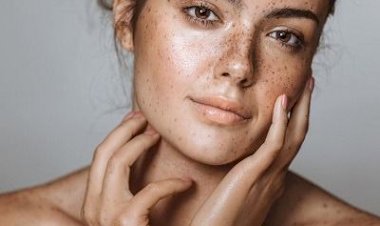 النمش.. أسبابه وطرق علاجه الطبيعية والطبية