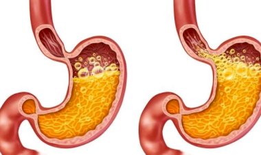 كل ما تحتاج معرفته عن ارتجاع المريء.. الأسباب والأعراض وخيارات العلاج