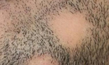 تقرير عن ثعلبة الذقن.. الأسباب والأعراض وطرق العلاج