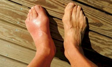 تعرف على أسباب وعلاج ارتفاع اليوريك أسيد