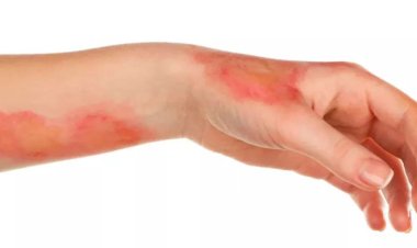 دليل شامل للتعامل مع الحروق: أنواعها وطرق علاجها حسب الدرجة