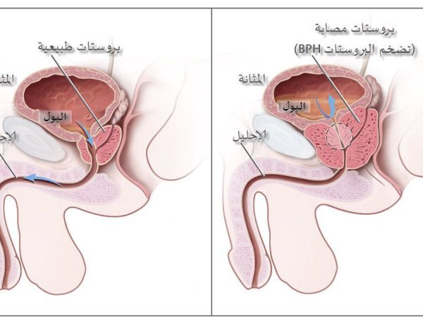 تقرير شامل عن تضخم البروستاتا: الأسباب و الأعراض والعلاج