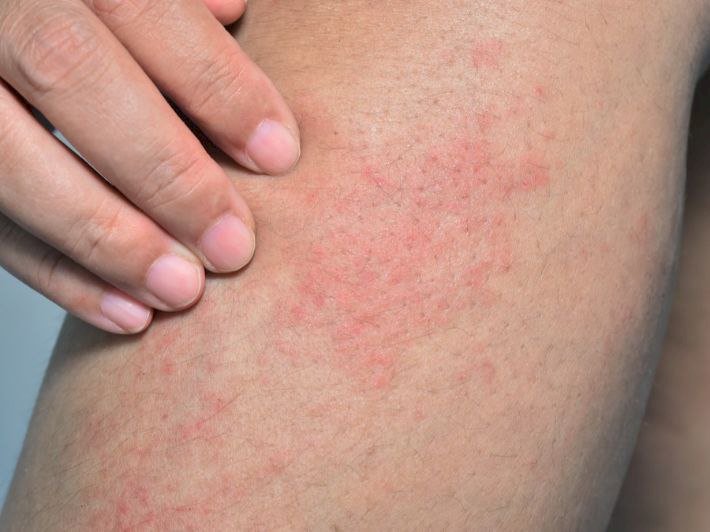 البقع الحمراء على الجلد: الأسباب والعلاج