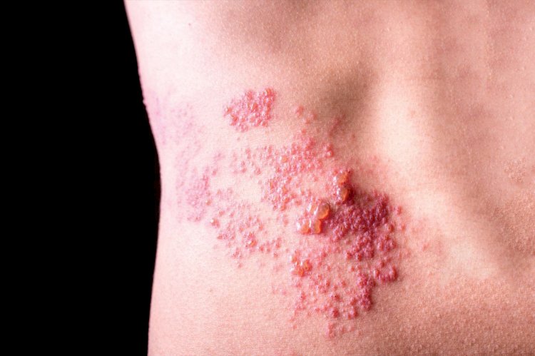 الحزام الناري: أخطر مضاعفاته وأهم طرق الوقاية