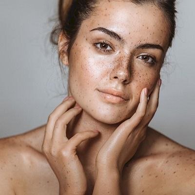 النمش.. أسبابه وطرق علاجه الطبيعية والطبية