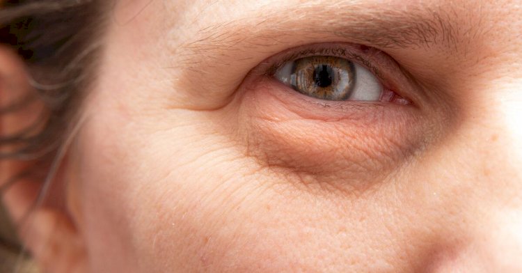 طرق فعّالة لعلاج انتفاخ تحت العين واستعادة نضارة الوجه