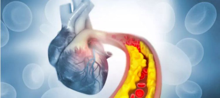 انسداد وتصلب الشرايين.. الأعراض والأسباب والعلاج والوقاية