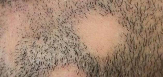 تقرير عن ثعلبة الذقن.. الأسباب والأعراض وطرق العلاج