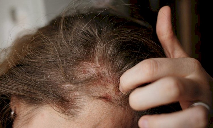 ينتشر بين طلاب المدارس.. أعراض فطريات الرأس