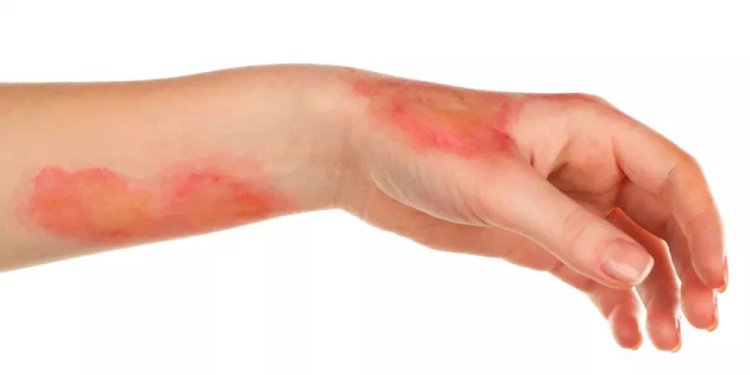 دليل شامل للتعامل مع الحروق: أنواعها وطرق علاجها حسب الدرجة