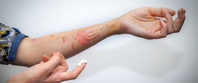 إسعافات وعلاج الحروق من الدرجة الأولى