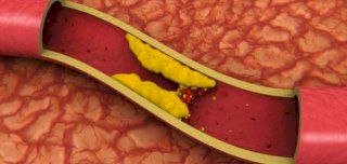 تعرف على أسباب ارتفاع كوليسترول الدم