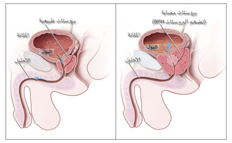 تقرير شامل عن تضخم البروستاتا: الأسباب و الأعراض والعلاج